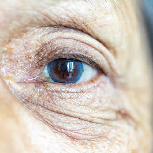 Degeneración Macular Asociada a la Edad (DMAE)