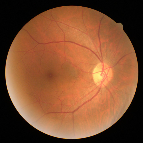 Edema macular diabético (EMD)